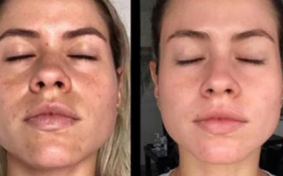 PRP facial ¿Qué es? ¿Qué beneficios tiene?