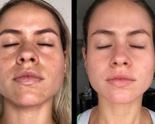 PRP facial ¿Qué es? ¿Qué beneficios tiene?