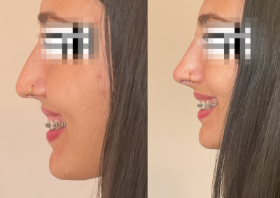 rinomodelación sin cirugía antes y después