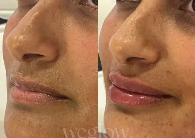 Antes y después de aumento de labios