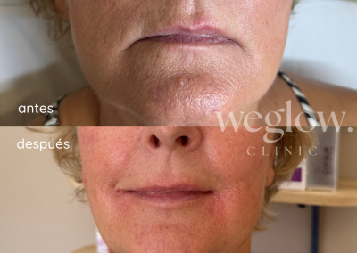 Elevación de comisuras