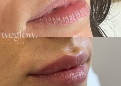 aumento de labios benidorm