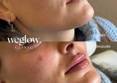 Aumento de labios en Benidorm