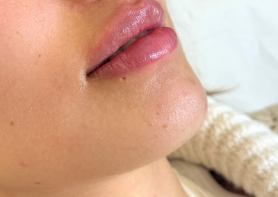 Aumento de labios
