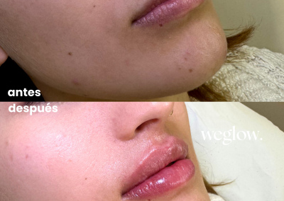 Aumento de labios antes y después en Benidorm