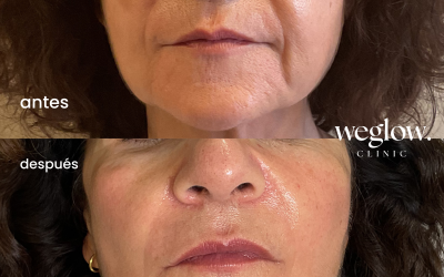 Eliminación de líneas de marioneta: rejuvenece tu rostro con medicina estética