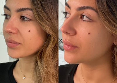 Eliminación de surcos nasogenianos