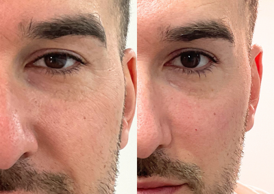 Eliminación de surcos nasogenianos antes y después