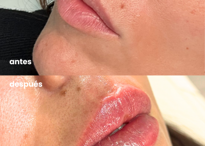 Aumento de labios antes y después