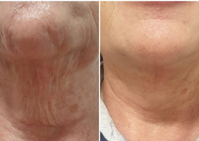 como tener un Cuello más terso sin cirugía