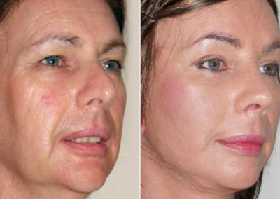Rejuvencimiento facial sin cirugía