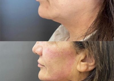 Quitar la papada solución