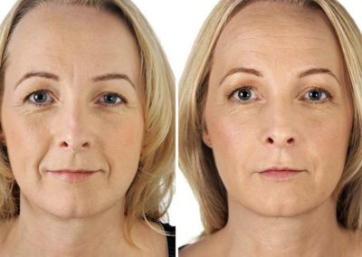 lifting sin cirugía en Benidorm