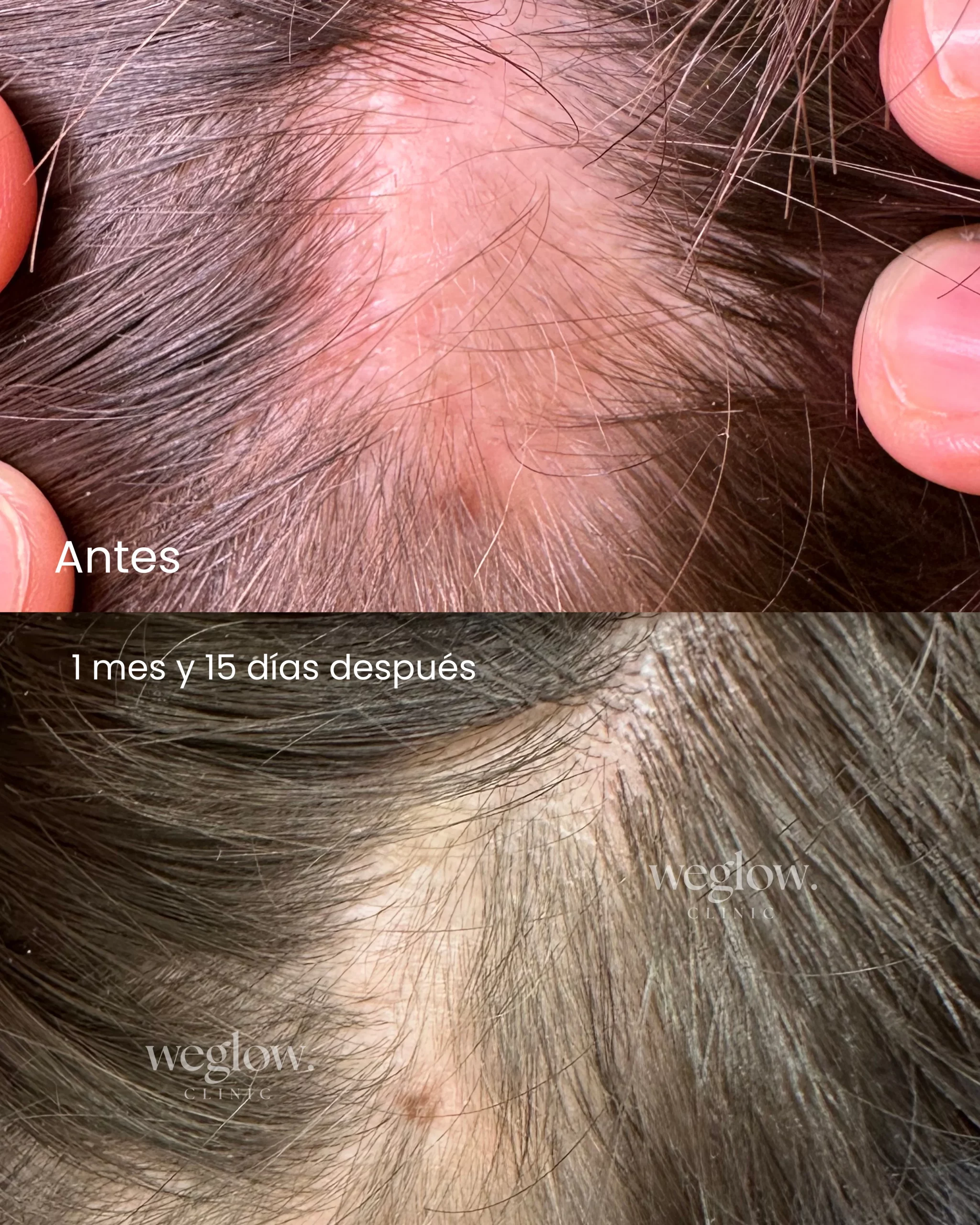 1 mes y 15 días después