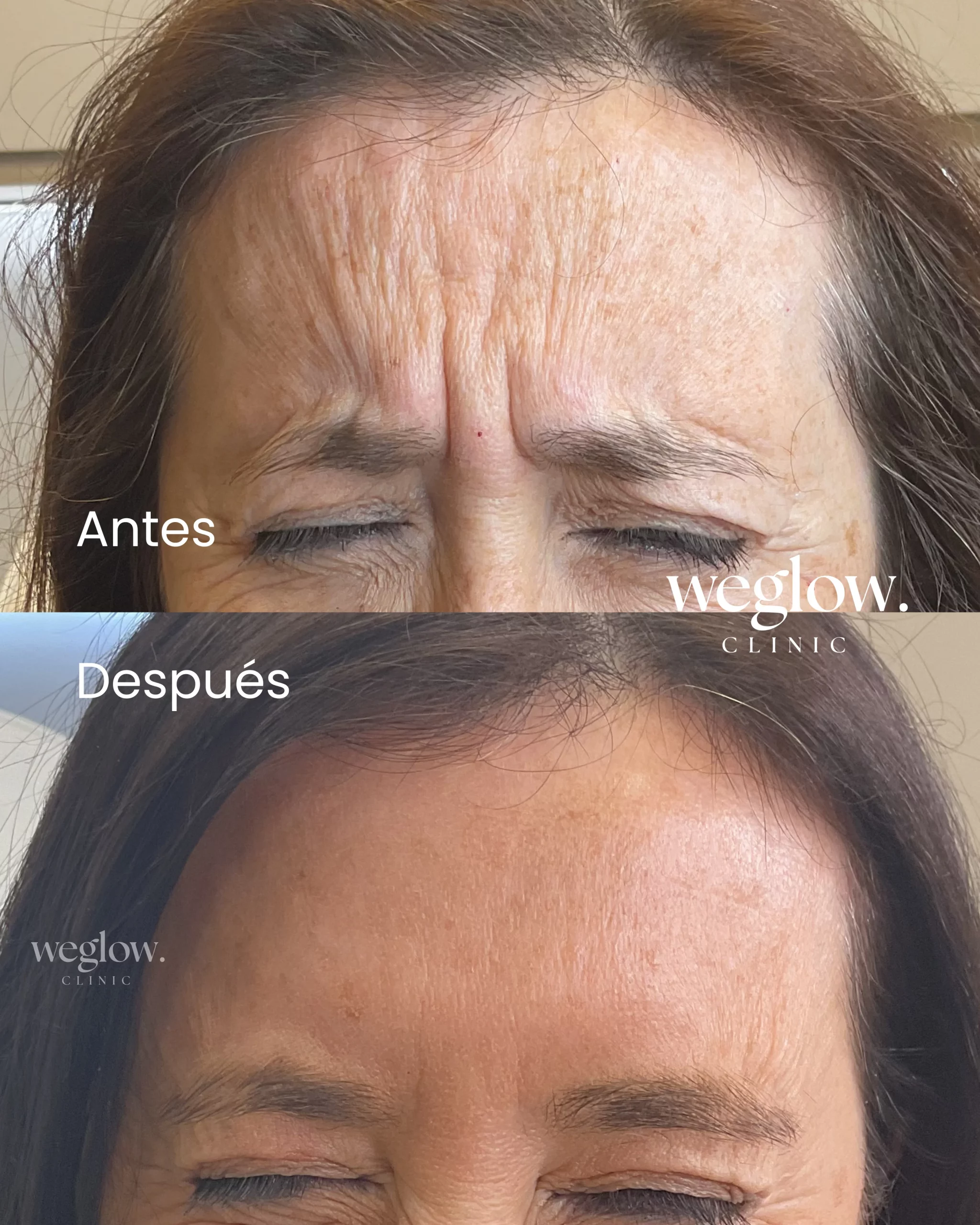 Eliminacion arrugas weglow clinic