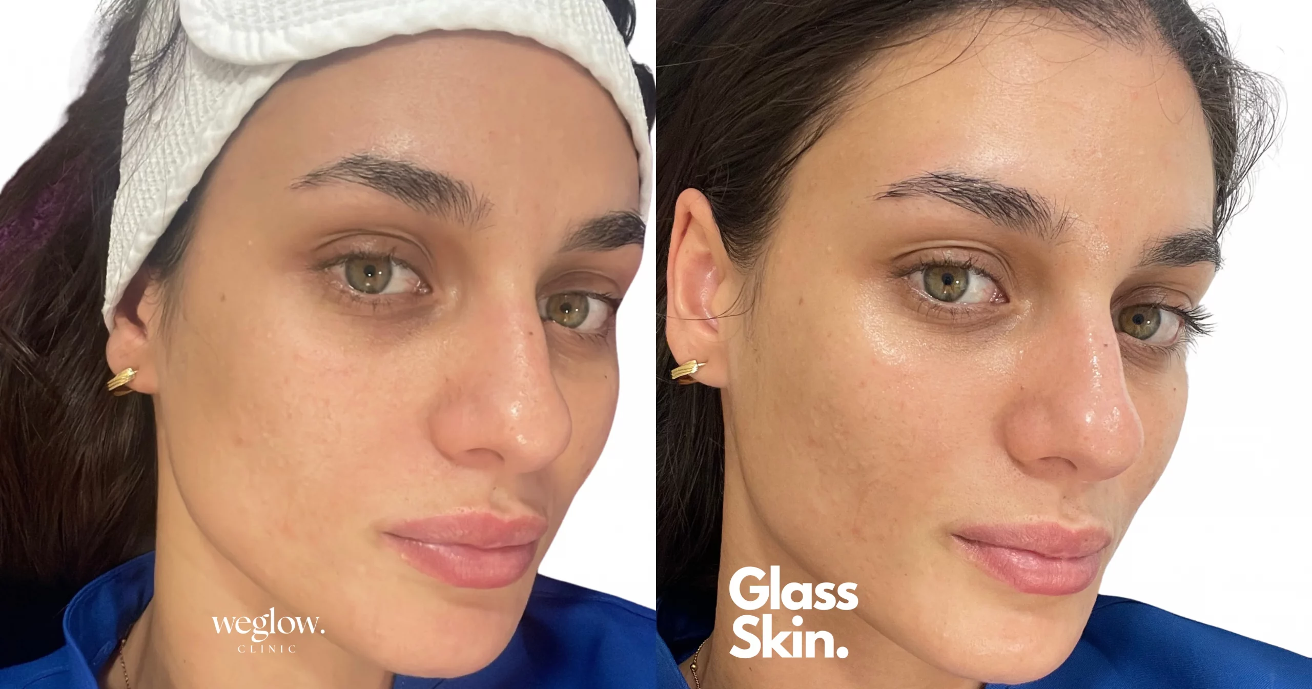 Glass Skin weglow clinic Glass Skin weglow clinic
