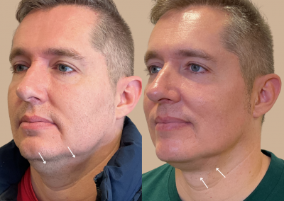 Eliminación de papada sin cirugía