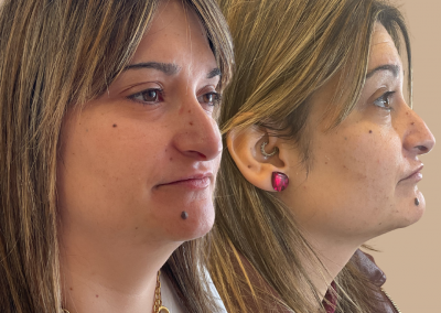 Eliminación de papada con laser y sin cirugía