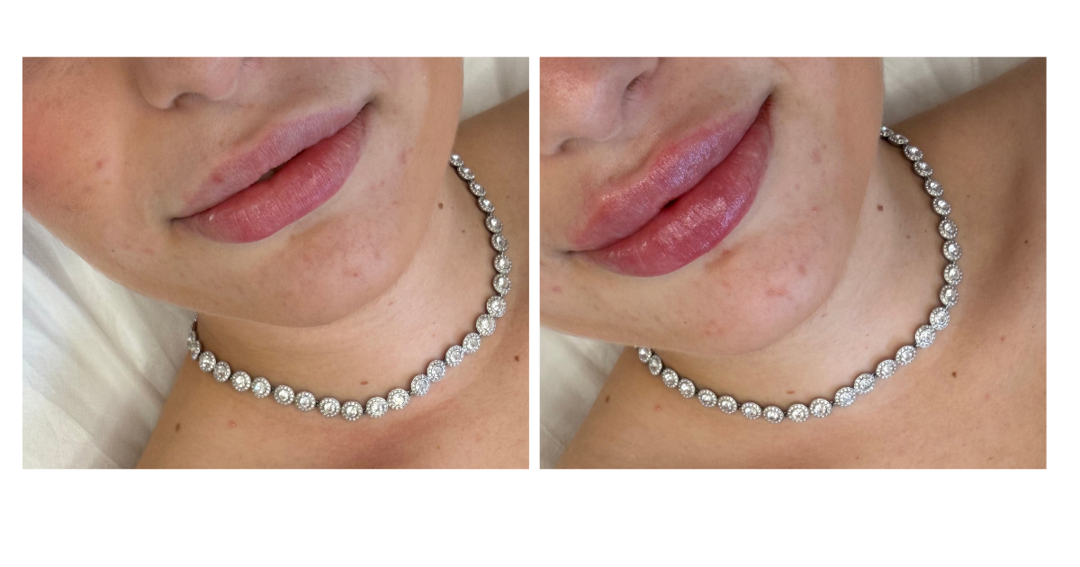 Aumento de labios en Weglow clinic