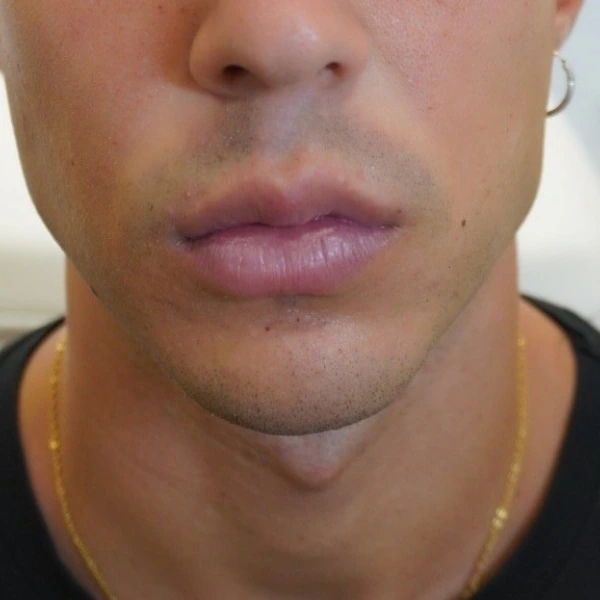 Antes