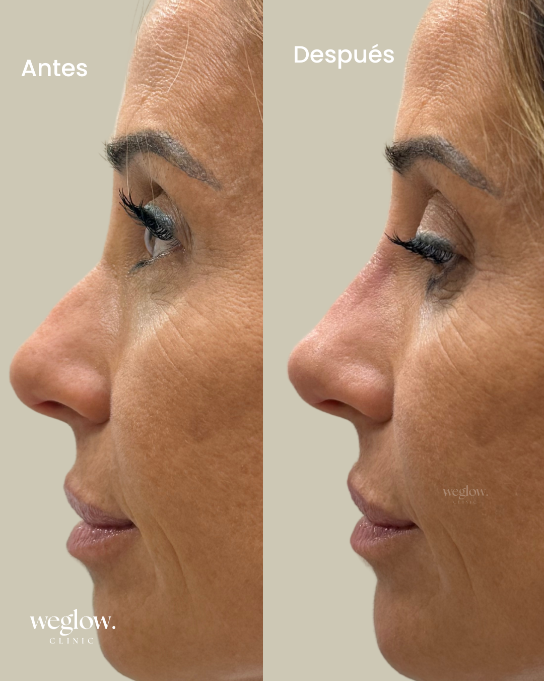 Rinomodelación sin cirgugia en Weglow Clinic.