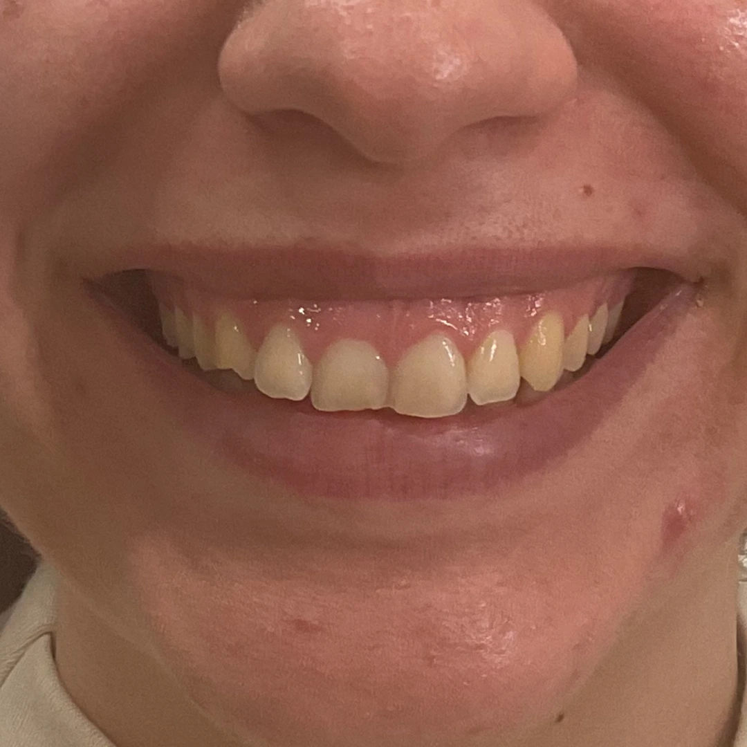 Antes
