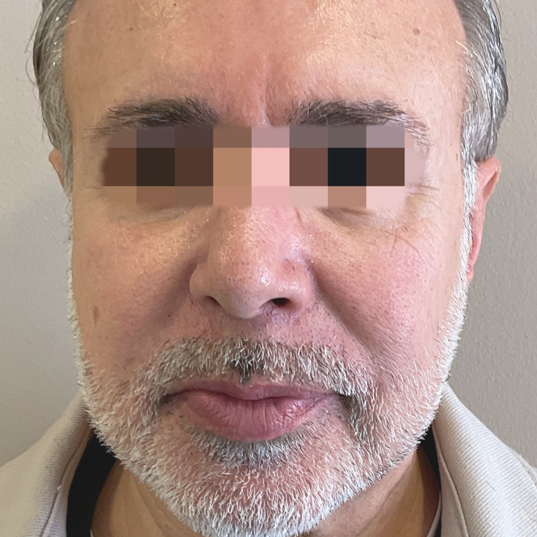 Antes