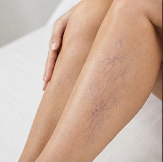 eliminacion de varices y arañas